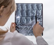 ExcelsiusGPS σκολίωση