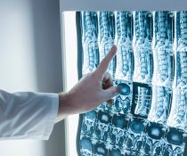 νευρώνες παράλυση ηλεκτρική διέγερση