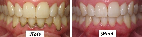 Περιοδοντίτιδα