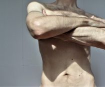 γυναικομαστία