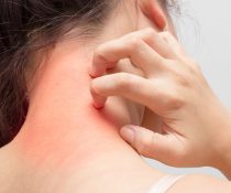 δερματίτιδα