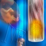 IVF