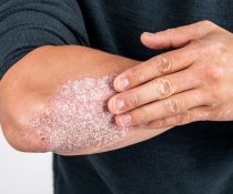 psoriasi
