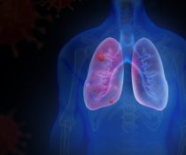 pnevmonia aktinografia σύσταση