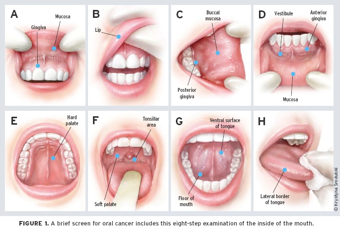 Cancer of mouth