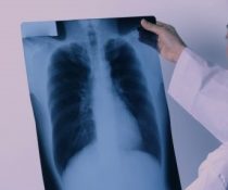 πνευμονική αρτηριακή υπέρταση ακτινογραφία πνευμόνων