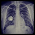 Βηματοδότης σε ακτινογραφία