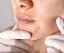 Πρόσωπο με ροδόχρους ακμή