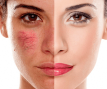 ευρυαγγείες προσώπου