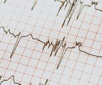 κίνδυνος θανατηφόρου εμφράγματος σε υπερηχογράφημα καρδιάς αιφνίδιο θάνατο