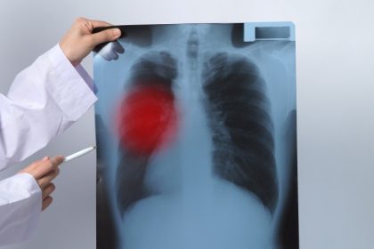 καρκίνος του πνεύμονα
