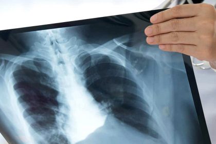 Καρκίνος του Πνεύμονα
