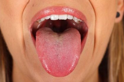 Μύκητες στη γλώσσα: Συμπτώματα, διάγνωση και θεραπεία