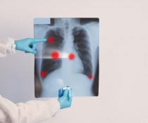 πνευμονική ίνωση μετά από covid-19 σε ακτινογραφία