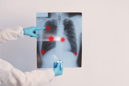 πνευμονική ίνωση μετά από covid-19 σε ακτινογραφία