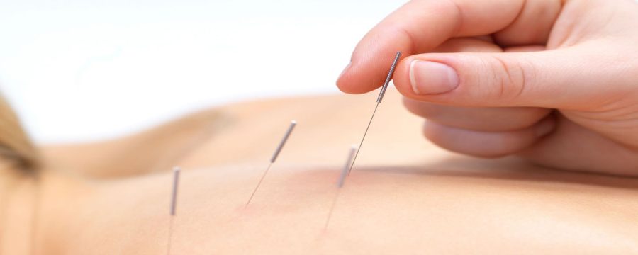 βελονισμός άγχος βελόνες σε πλάτη γυναίκας αρθρίτιδα
