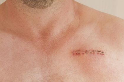 βηματοδότης βιοδιασπώμενος