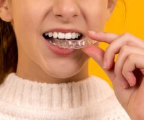 INVISALIGN