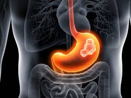 Καρκίνος στο πεπτικό σύστημα