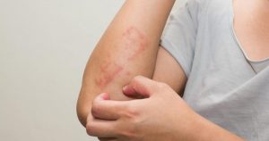 λειχήνες δέρματος κόκκινα εξανθήματα στο χέρι 