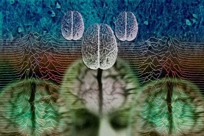 σύστημα τεχνητής νοημοσύνης για άνοια