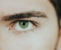 άντρας με Αιμάτωμα στο μάτι από πίεση - Υπόσφαγμα