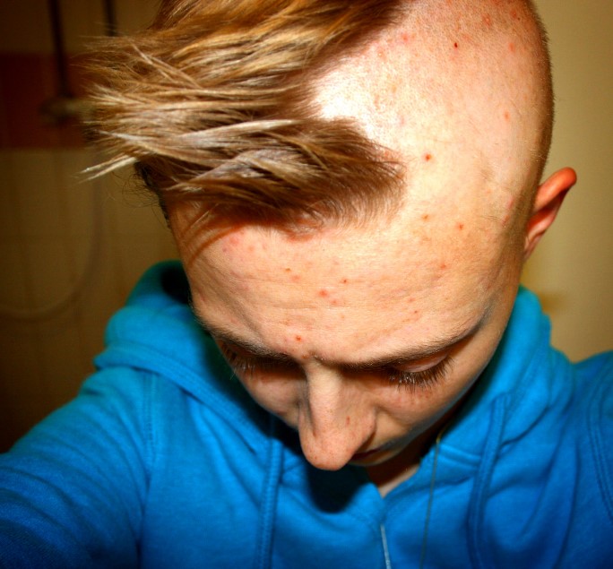 Tριχοτιλλομανία σε έφηβο 