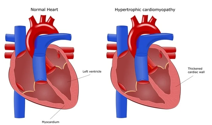 Υπερτροφική μυοκαρδιοπάθεια