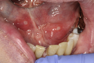 στοματιτιδα απο αγχος