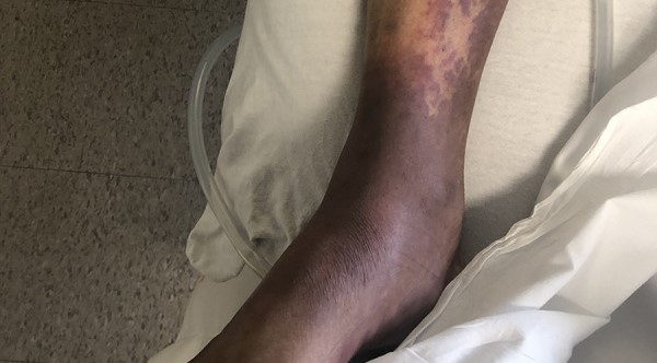 σηψαιμία, σήψη φωτογραφίες