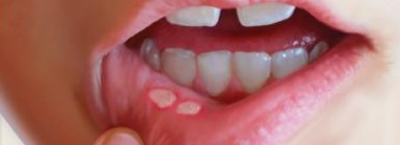 στοματίτιδα φωτογραφίες