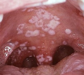 στοματιτιδα φωτογραφίες